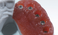 采用 ACEO® 3D 打印的硅橡胶人工牙龈。（图片： Josef Schweiger，慕尼黑大学附属医院口腔修复科）