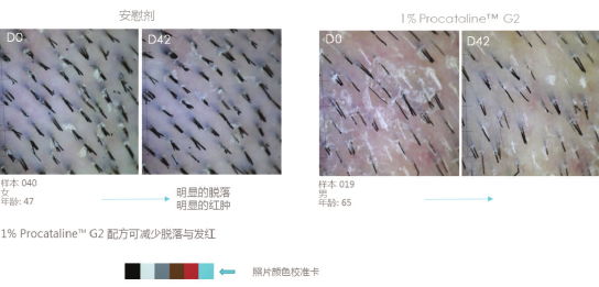 图9一头皮发红、角质脱落改善情况
