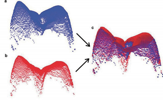 图 3：使用共极化光学相干断层摄影术（CP-OCT）得到的三维表面成像。消融前三维表面（a）； 消融后三维表面（b）；消融前后三维表面比对以确定被去除的组织的体积（c）。见参考文献 4 。由加州大学旧金山分校的 Daniel Fried 提供。