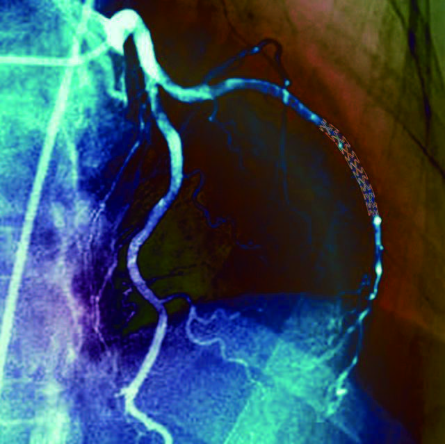 图 | 血管造影显示一位 52岁病人放了支架的冠状动脉（来源：Zephyr/Science Source）