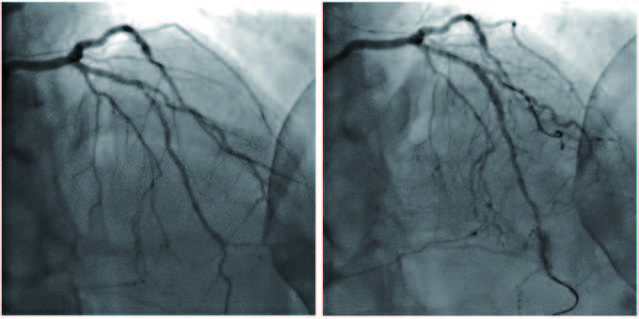 图 | 同一患者在接受支架放置前（左）和支架放置后（右）（来源：NYU Langone Health）