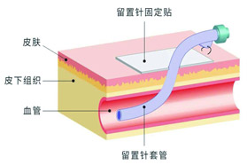 静脉留置针探究新型静脉输液方式