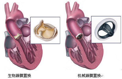 介入人工生物心脏瓣膜产品获批上市