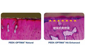 应用于下一代脊柱植入物的生物材料