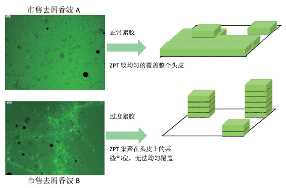 图1. ZPT 在正常絮胶和过度絮胶中对头皮沉积的示意图