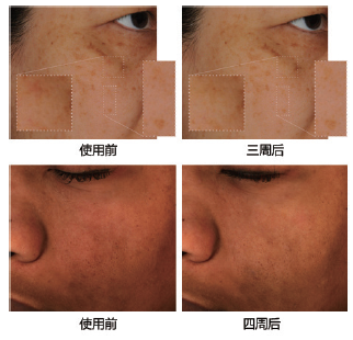 Sederma 推出的专门针对色素过度沉着的肤 色调节剂Mediatone，它能让肤色变得更加均 匀透亮