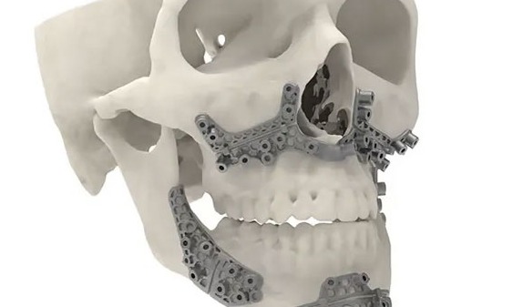 3D Systems获FDA关键许可，青少年骨科业务将成增长新引擎