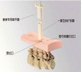 SLS 打印技术助力脊柱融合手术