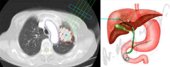 临床前沿：使用精准放疗“炸弹”靶向治疗肝脏肿瘤