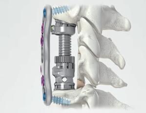 全球医疗植入物市场持续增长