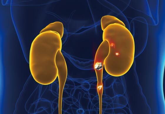 为碎石术寻找新的激光源