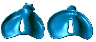 3D打印为唇腭裂儿童带去微笑