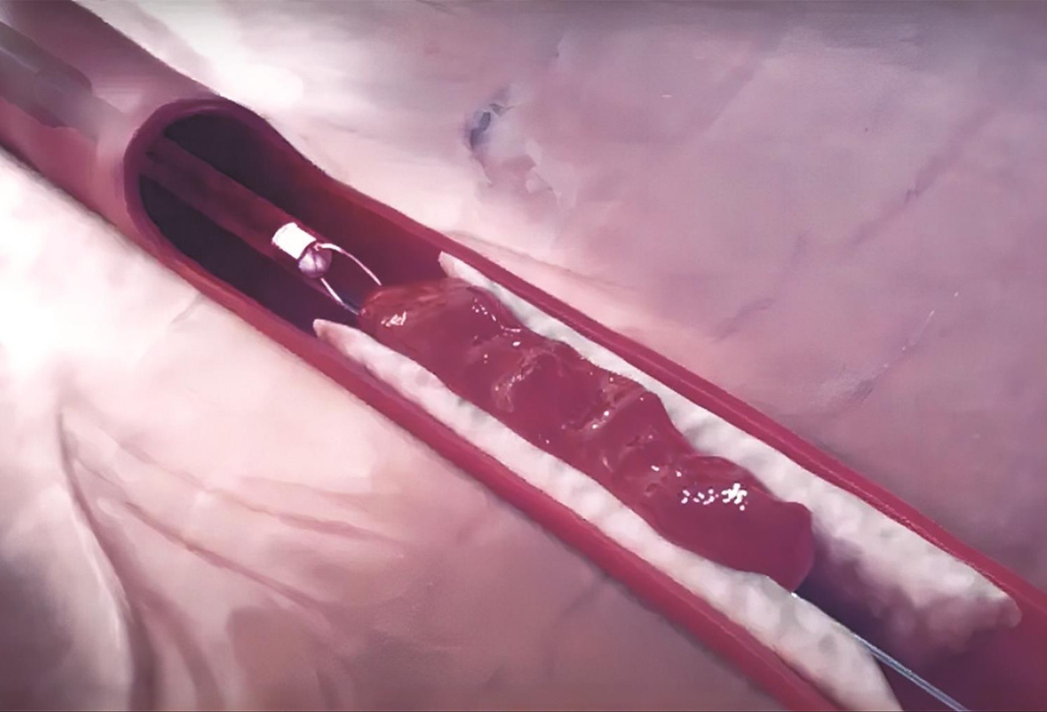 智能抽吸算法和导管如何加速血栓清除？