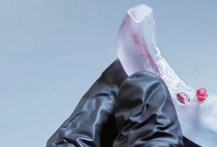 3D打印技术实现数字化植牙流程
